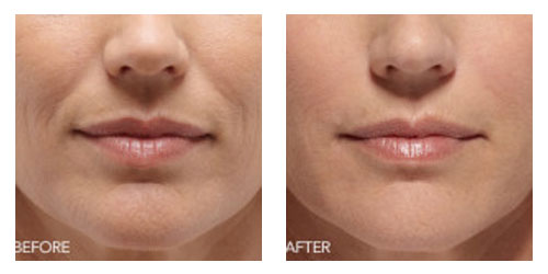 Belotero BeforeAfter