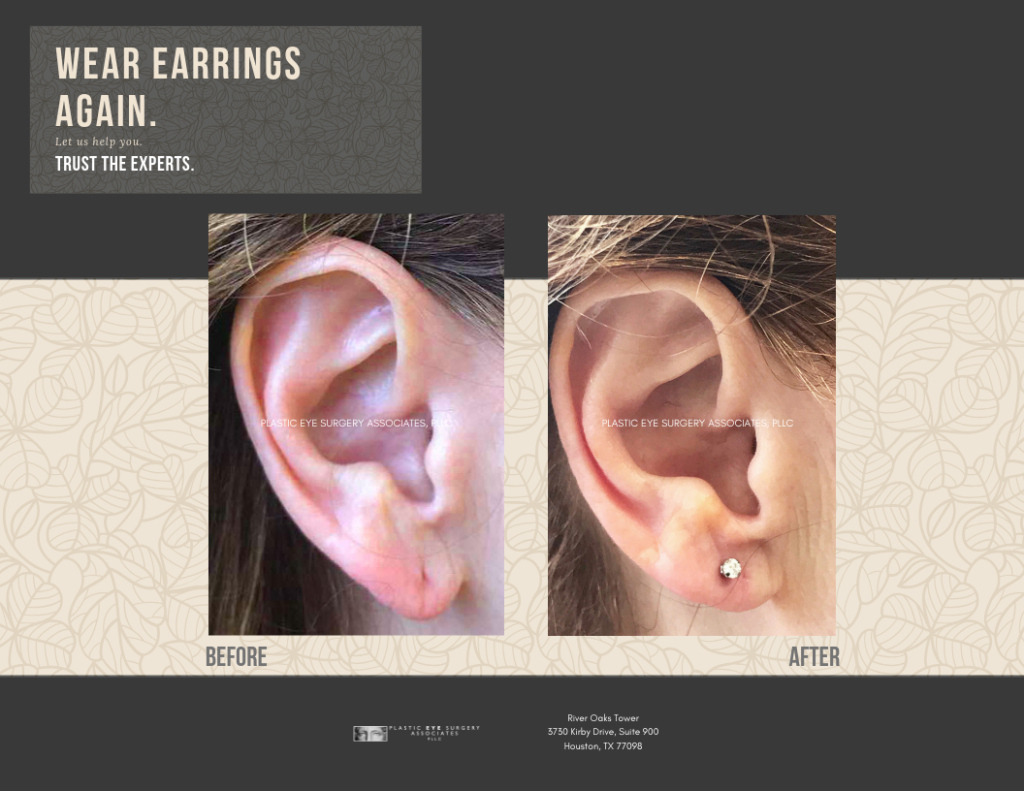 EarlobeSurgery01 1024x791 2