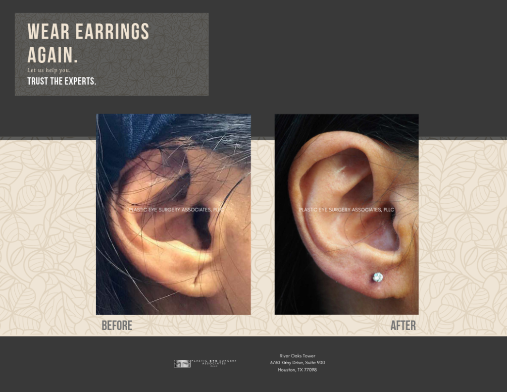 EarlobeSurgery02 1024x791 2