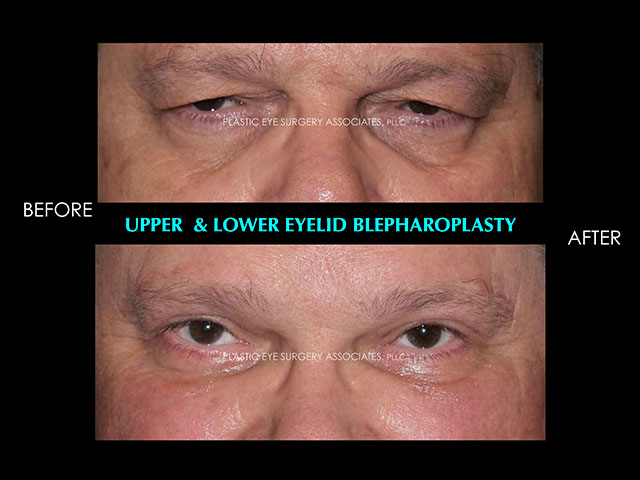 MaleLowerBlepharoplasty10 1