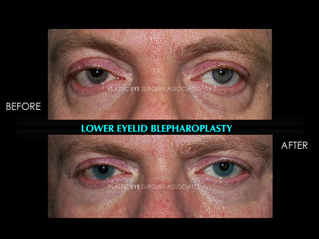 MaleLowerBlepharoplasty17