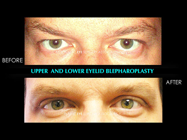 MaleLowerBlepharoplasty32 1