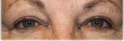 BLEPHAROSPASM TREATMENT bottom BLEPHAROSPASM TREATMENT bottom