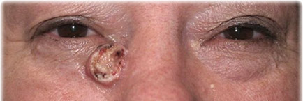 EYELID SKIN CANCER top EYELID SKIN CANCER top