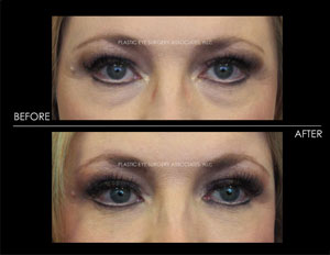 Pensacola FL Under Eye Filler