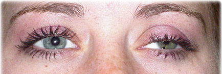 PTOSIS REPAIR top PTOSIS REPAIR top