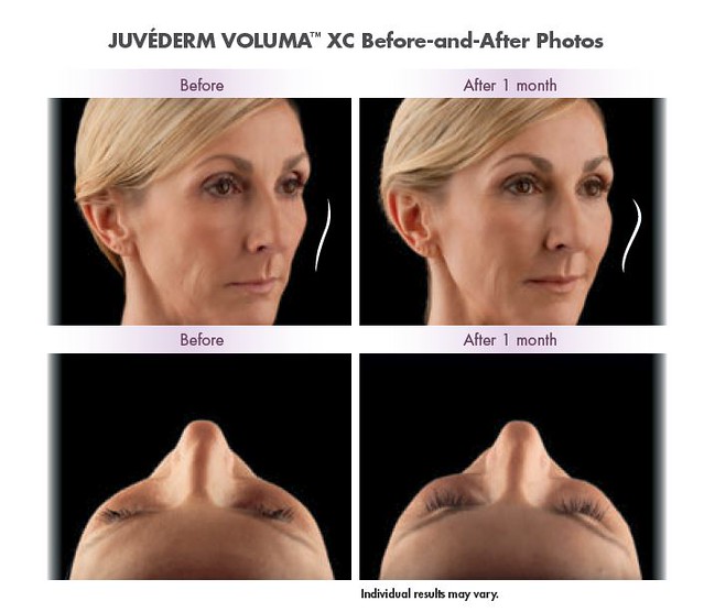 Voluma 2