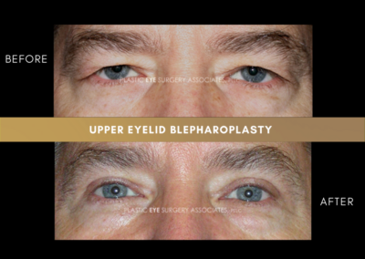 Upper Eyelid Aesthetics Photos 19