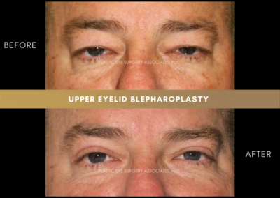Upper Eyelid Aesthetics Photos 22