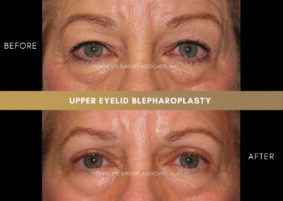 Upper Eyelid Aesthetics Photos 20