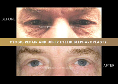 Eyelid Reshaping Photos 123