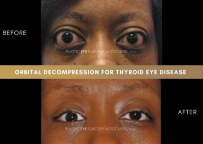 Thyroid Eye Disease Photos 5