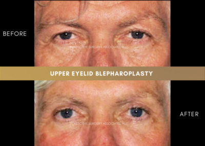Upper Eyelid Aesthetics Photos 17
