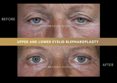 Lower Blepharoplasty Photos 22