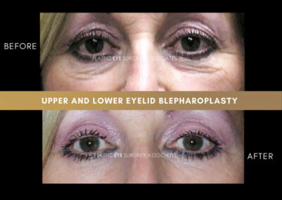 Lower Blepharoplasty Photos 23