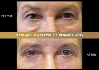 Lower Blepharoplasty Photos 24