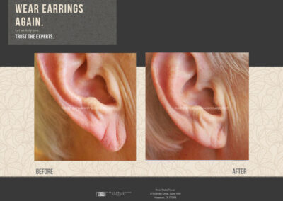 Before & After Earlobe Surgery 9