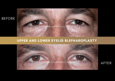 Male Blepharoplasty Photos 20