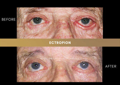 Ectropion/Entropion Photos 12