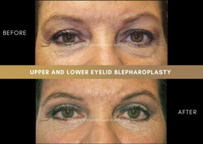 Lower Blepharoplasty Photos 27