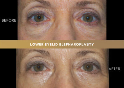 Lower Blepharoplasty Photos 28