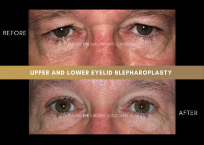 Male Blepharoplasty Photos 19