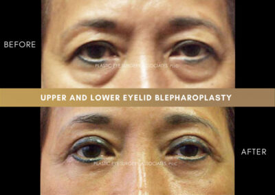 Lower Blepharoplasty Photos 30