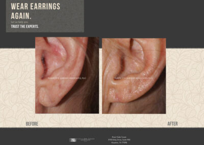 Before & After Earlobe Surgery 10