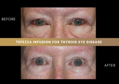 Thyroid Eye Disease Photos 20