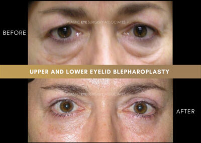 Lower Blepharoplasty Photos 31