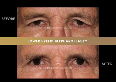 Male Blepharoplasty Photos 18