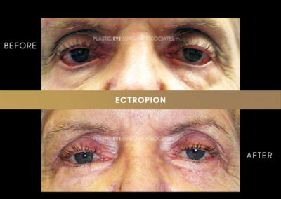 Ectropion/Entropion Photos 14