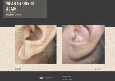 Before & After Earlobe Surgery 11