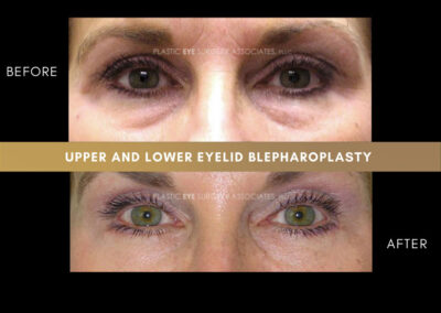 Lower Blepharoplasty Photos 32