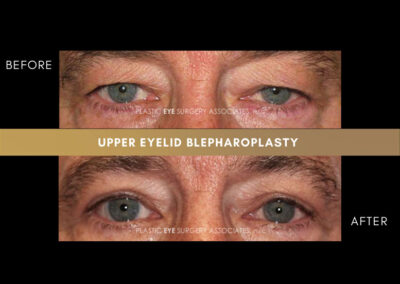 Male Blepharoplasty Photos 17