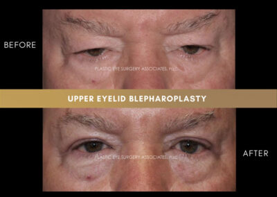 Eyelid Reshaping Photos 140