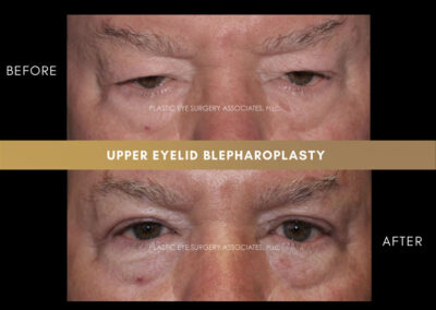 Male Blepharoplasty Photos 16