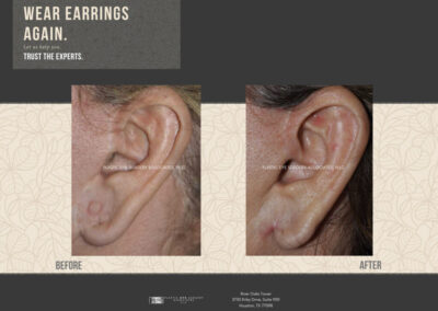 Before & After Earlobe Surgery 12