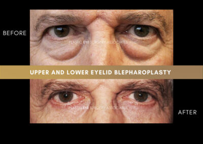 Male Blepharoplasty Photos 15