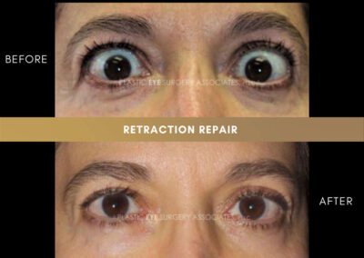 Retraction Photos 24