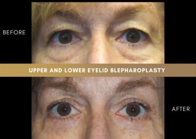 Lower Blepharoplasty Photos 33