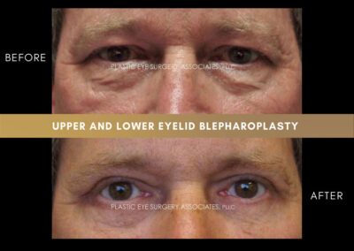 Male Blepharoplasty Photos 13