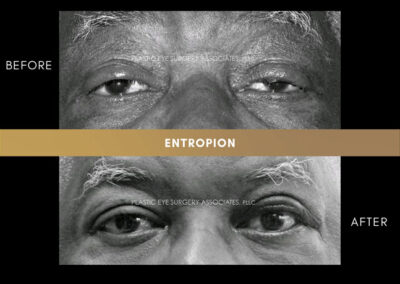 Ectropion/Entropion Photos 17