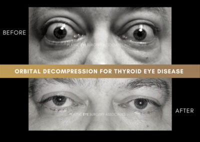 Thyroid Eye Disease Photos 23