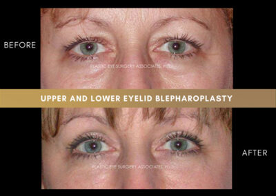 Lower Blepharoplasty Photos 35