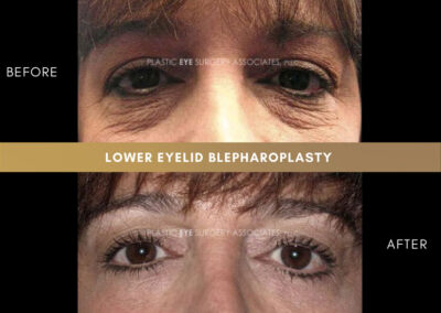 Lower Blepharoplasty Photos 36