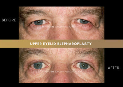 Eyelid Reshaping Photos 144