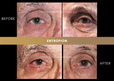 Ectropion/Entropion Photos 18