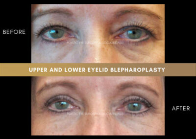 Lower Blepharoplasty Photos 38