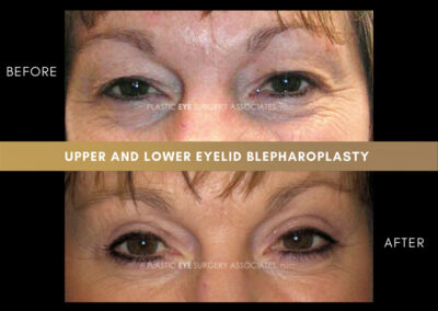 Lower Blepharoplasty Photos 39